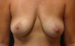 Breast Augmentation