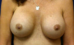 Breast Augmentation