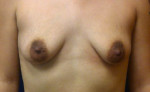 Breast Augmentation