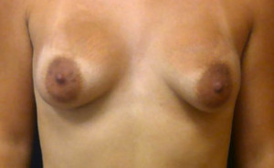 Breast Augmentation