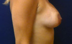 Breast Augmentation