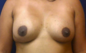 Breast Augmentation Case 4198 After Photo Breast Augmentation