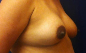 Breast Augmentation Case 4198 Before Photo Breast Augmentation