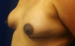 Breast Augmentation