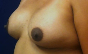 Breast Augmentation Case 4198 After Photo Breast Augmentation