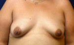 Breast Augmentation