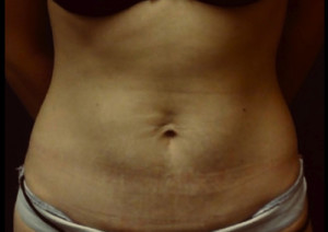 Abdominoplasty