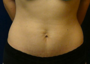 Abdominoplasty