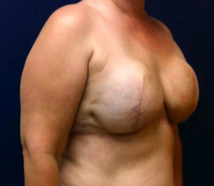 Breast Reconstruction