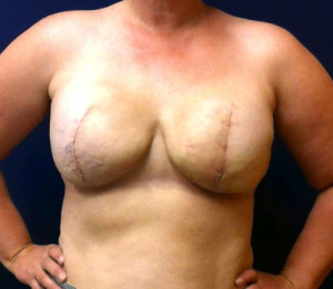 Breast Reconstruction