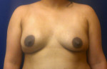 Breast Revision