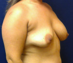 Breast Revision