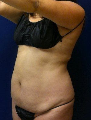 Liposuction Case 4276 Before Photo Liposuction