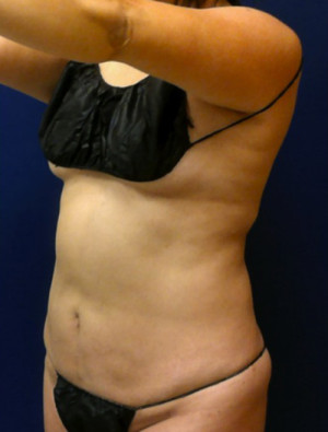 Liposuction Case 4276 After Photo Liposuction