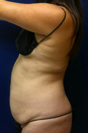 Liposuction Case 4276 Before Photo Liposuction