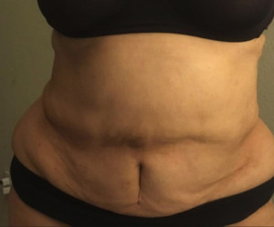 Liposuction