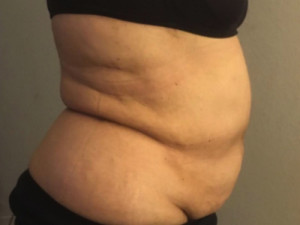 Liposuction