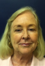 Facelift/Necklift
