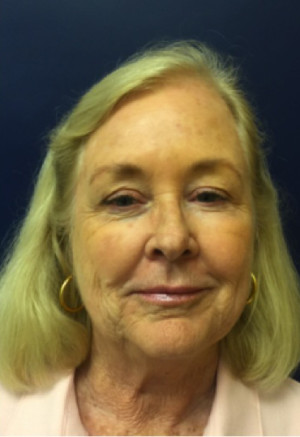 Facelift/Necklift