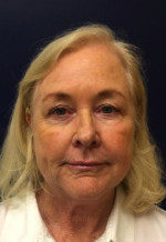 Facelift/Necklift