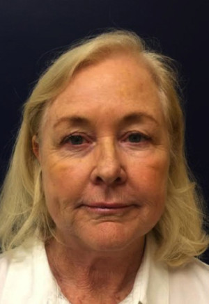 Facelift/Necklift