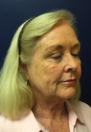 Facelift/Necklift