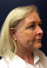 Facelift/Necklift