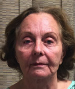 Facelift/Necklift