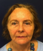 Facelift/Necklift