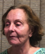 Facelift/Necklift