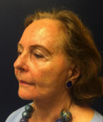 Facelift/Necklift