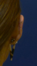 Facial Trauma/Skin Cancer