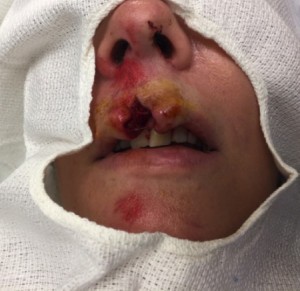 Facial Trauma/Skin Cancer