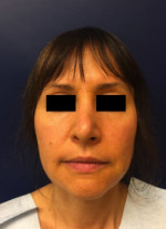 Rhinoplasty