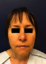 Rhinoplasty