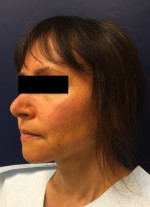 Rhinoplasty