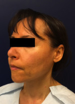 Rhinoplasty