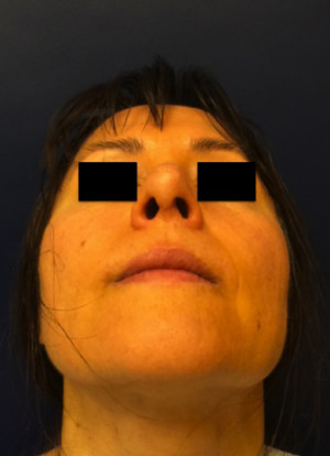 Rhinoplasty
