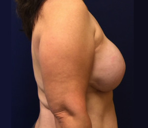 Breast Reconstruction