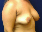 Breast Augmentation/Mastopexy