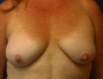 Breast Augmentation/Mastopexy