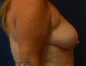 Breast Augmentation/Mastopexy