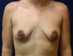 Breast Augmentation/Mastopexy