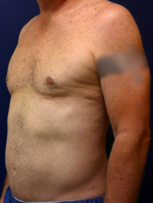 Liposuction Case 4526 After Photo Liposuction