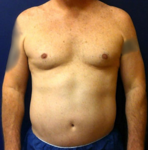 Liposuction Case 4526 Before Photo Liposuction