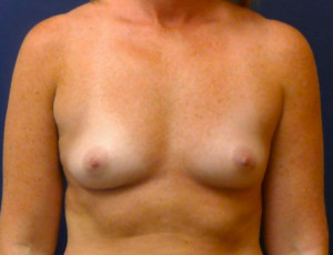 Breast Augmentation Case 4552 Before Photo Breast Augmentation