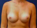 Breast Augmentation