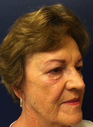 Facial Trauma/Skin Cancer