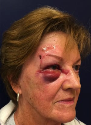 Facial Trauma/Skin Cancer
