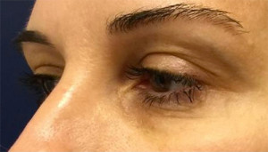 Blepharoplasty